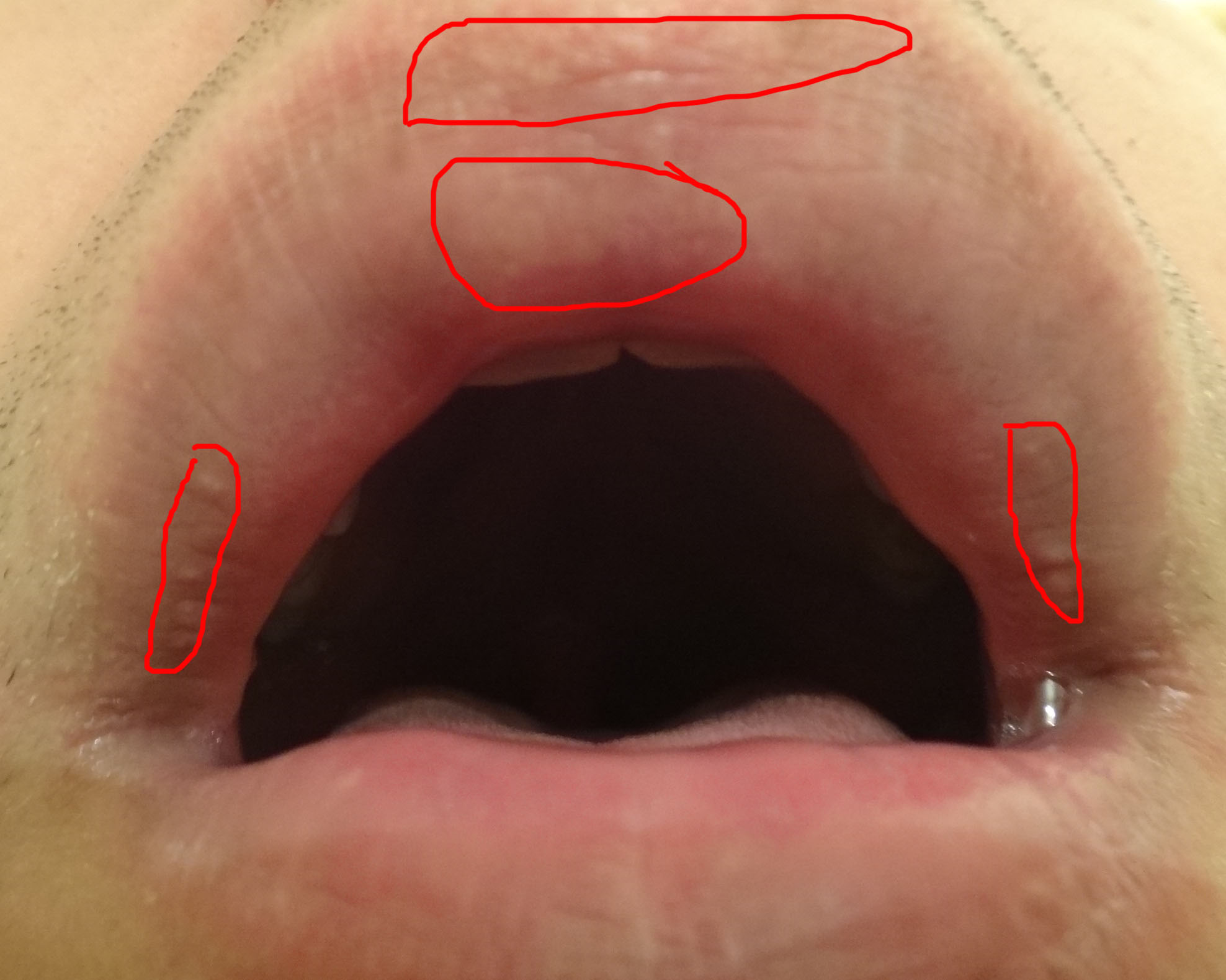 Как проводится увеличение губ — блог медицинского центра ОН Клиник